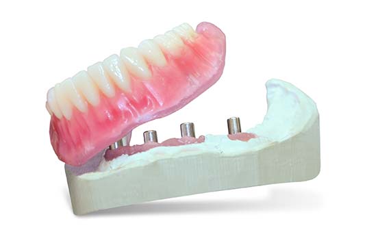 Implant Supported Dentures